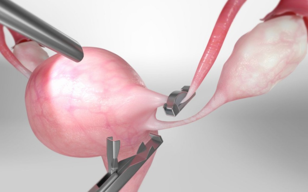 Hysteroscopic Procedures